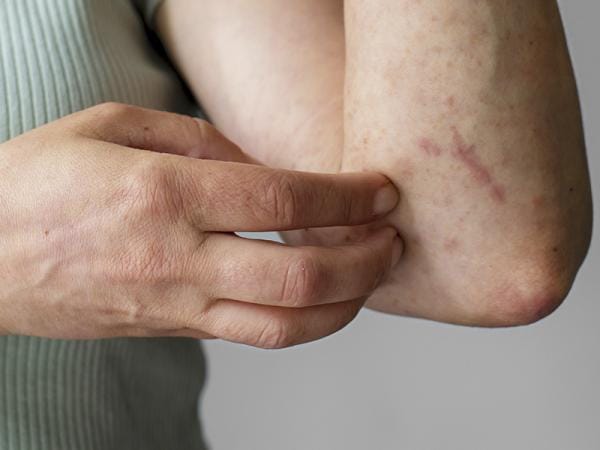 Suma Puebla 2 mil 750 casos acumulados por dengue: Salud