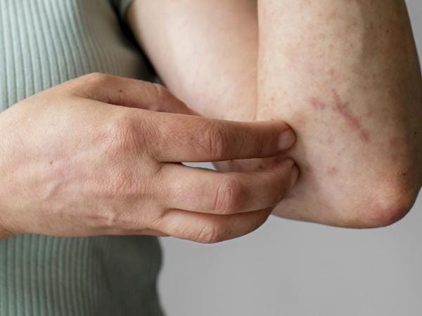Puebla, sin contagios ni defunciones por dengue en las últimas 24 horas